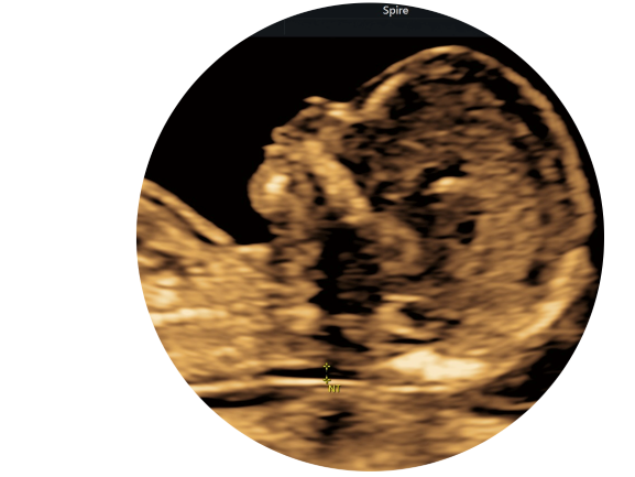 Nuchal Translucency Scan