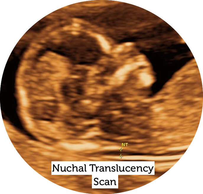 Nuchal Translucency Scan
