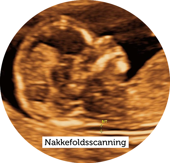 Nakkefoldsscanning