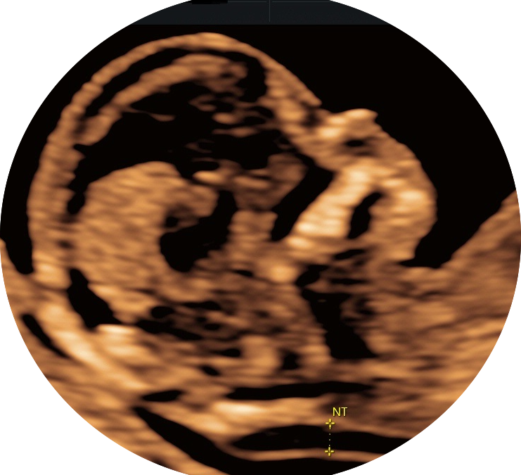 Nuchal Translucency Scan